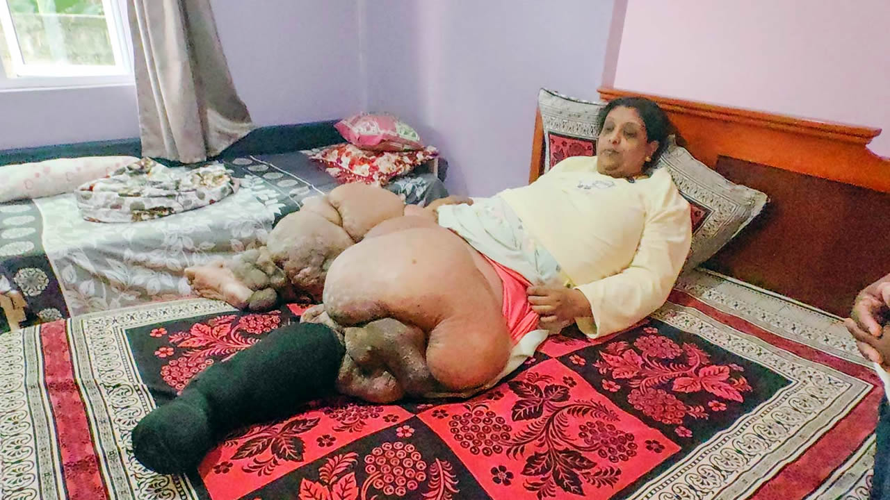 Atteinte d’éléphantiasis, communément appelé « elephant leg », Leena Doohkhee est alitée depuis 2016, sa maladie ayant considérablement réduit sa mobilité.