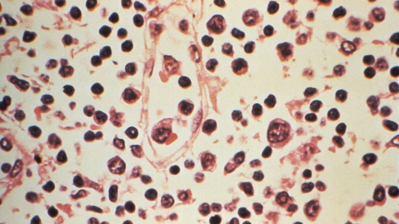L'hantavirus agite une complosphère hantée par le Covid