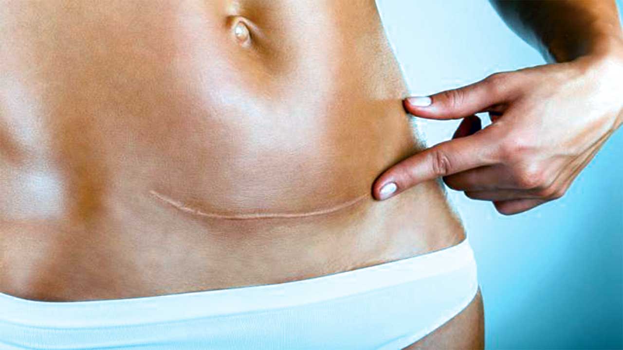 Births by caesarian section: Reasons behind the rising trend