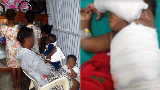 Son petit-fils grièvement brûlé : squatteuse, mère de six enfants et grand-mère, elle en appelle à la générosité des Mauriciens 
