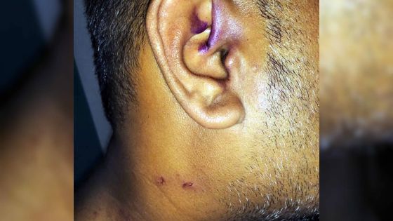 Allégations de brutalité policière - Veenaye : «Akoz enn kontravansyon gagn bate koumsa ?»