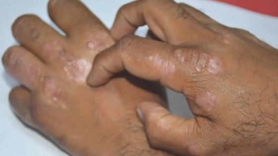 Santé - Maladies de peau : plus de 9 000 cas par mois en 2019