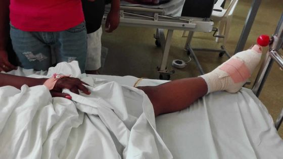 À Bambous : une receveuse a le pied écrasé en tombant d’un bus