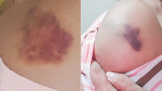 Maltraitance - De l’enfer du mariage arrangé à la violence conjugale : le combat de Shalinee