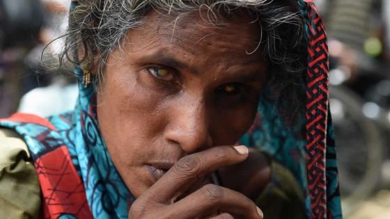 36 millions d'aveugles dans le monde, trois fois plus attendus en 2050