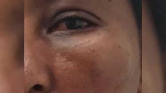 Après une agression, elle perd l’usage d’un œil - Caroline : «J’ai peur de perdre mon emploi»