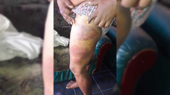 Allégation de brutalité policière : son corps couvert d’ecchymoses