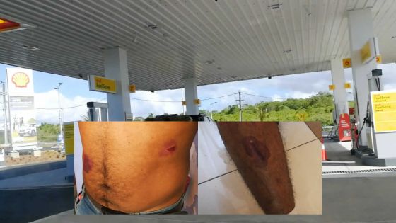 Pour Rs 100 d’essence : un conducteur dit avoir été agressé par quatre pompistes