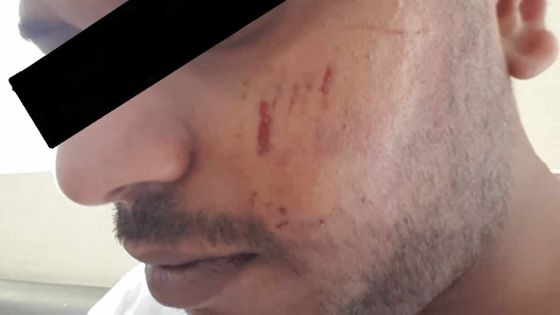 Mordu à la joue par son frère