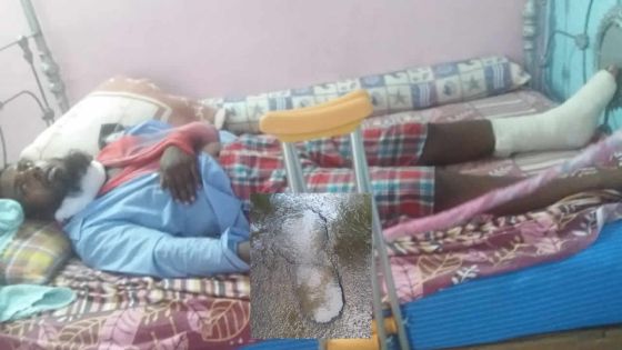 Suite d’une négligence de la mairie : un motocycliste fracture clavicule et orteils en raison d’un nid de poule 