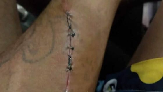 Vol avec violence - Oodith : «Linn koup koup mwa partou ek enn cutter»