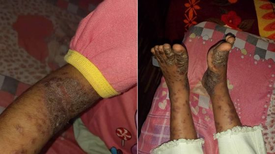 Appel à la solidarité : souffrant du syndrome hyper-IgE, Chloé a besoin de vous