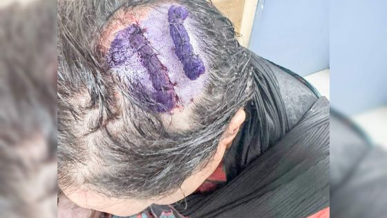 Nuit sanglante à Plaine-Verte : une femme scalpée à coups de sabre, deux hommes blessés