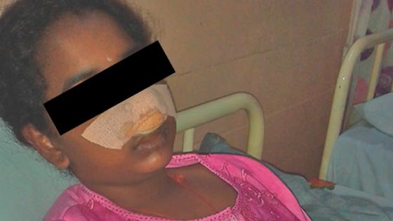 Après une chute à l’école : une fillette contrainte de porter deux incisives temporaires 