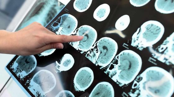 Dr Poonam Bissessur, psychiatre : «La cause de l’épilepsie inconnue dans 60 % des cas»