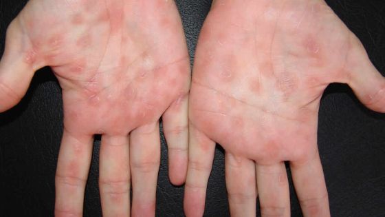 Maladie sexuellement transmissible : la syphilis touche de plus en plus de jeunes