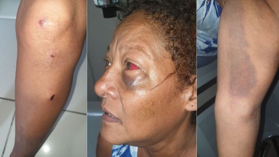 Avenue Berthaud, Quatre-Bornes - Brigitte, 58 ans, allègue : «J’ai été rouée de coups à cause d’une histoire d’héritage» 