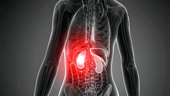 Rapport de The Lancet : Maurice parmi les pays les plus affectés par l’insuffisance rénale