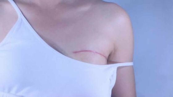 Anne Marie Mootoosamy : «La sécurité sociale néglige les victimes du cancer»