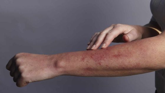 Lupus Alert : faire connaître la maladie pour mieux l’accepter