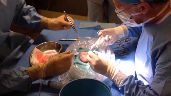 Transplantations rénales : des chirurgiens indiens pour les opérations