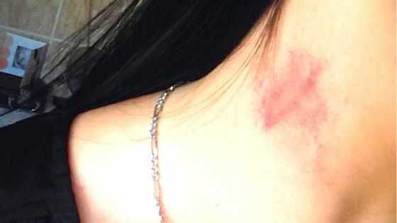 L’ado avait des suçons au cou – Relations entre deux mineures: un père désemparé