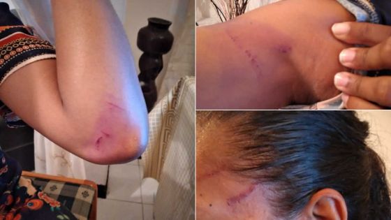 Violence domestique - Abigaël : «Il m’a dit d’acheter un miroir car je ne me reconnaîtrai plus…»