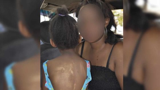 Dans un village du Nord : elle accuse la compagne de son père de l’avoir ébouillantée 