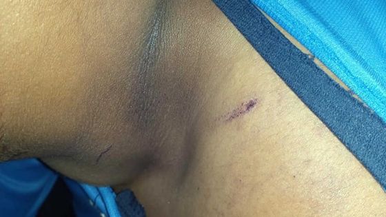 Accusé d’agression et de vol : le suspect retrouvé avec des blessures