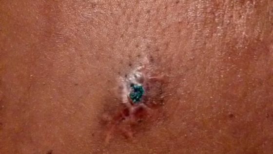 Un mois après une intervention chirurgicale, son calvaire continue