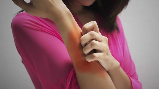 Karishma Babajee-Deenoo - Dermatologue au Wellkin Hospital de Moka : «La hausse de la syphilis est inquiétante»