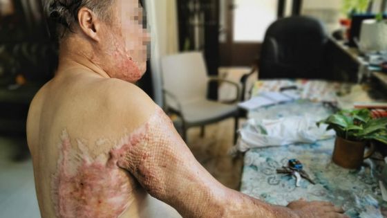 Attaqué à l’acide en deux occasions et aucune arrestation : Gaëtan, 68 ans, vit dans la peur 