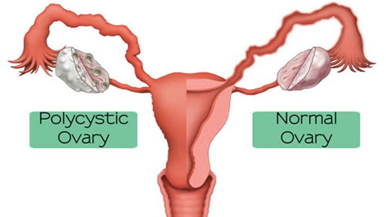 Polycystic Ovary Syndrome : Complicated Medical Condition but Can Be Treated