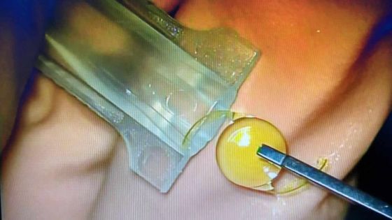 Les lentilles multifocales PanOptix pliables