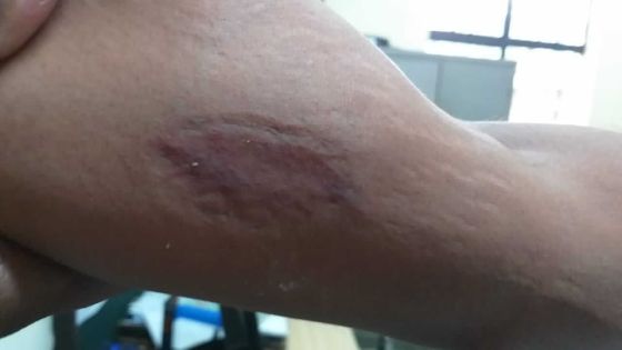 À Bel-Air/Rivière-Sèche : un policier mordu et sa collègue prise à la gorge lors d’une intervention 