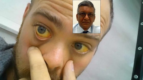 Dr Farouk Bholah : «La jaunisse obstructive est en hausse à Maurice»