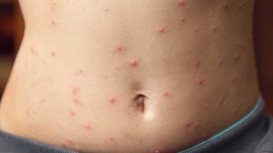 La rougeole toujours en hausse : 76 nouveaux cas enregistrés