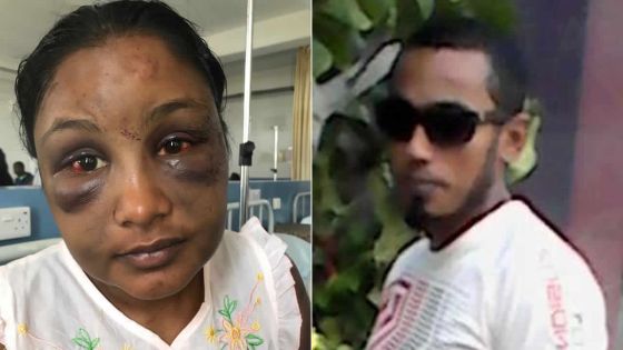 Ligotée, tabassée et défigurée par son mari - Yashna : «Je ne pensais pas survivre à cette atrocité» 