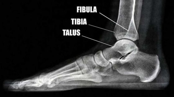 Elle a eu le tibia écrasé dans un accident de la route : les difficultés de Yasmine pour obtenir une pension d’invalidité 