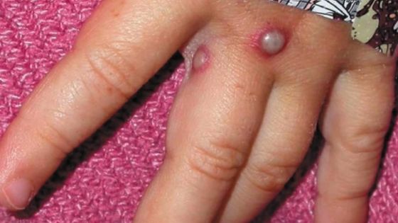 Mesure de sécurité - Variole du singe : Maurice commande déjà ses vaccins