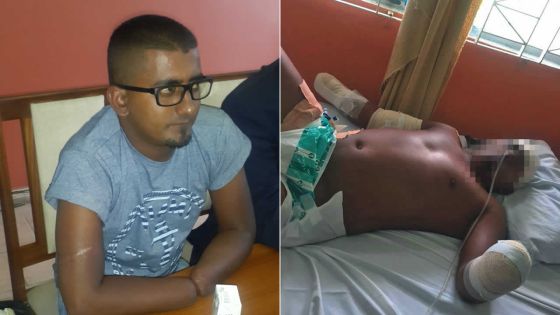 Aslam Noorsing condamné à vivre avec deux poignets sectionnés