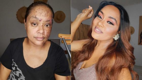 Victime d’un grave accident en février dernier : le combat sans relâche d’Estelle Riche