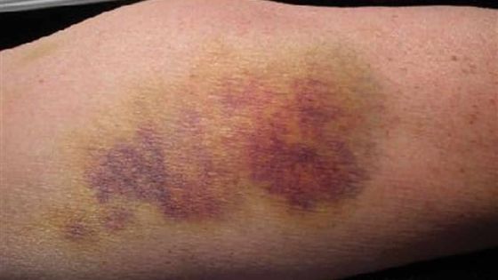 Après une chute : blessée dans un supermarché elle sera indemnisée