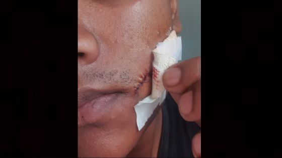 Mahébourg : un présumé pervers sexuel lui taillade la joue 