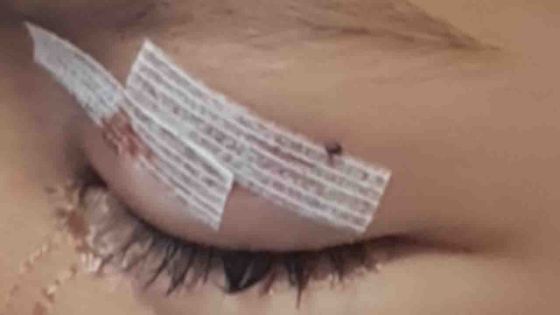 Un enfant de 3 ans mordu par un chien à l'œil gauche dans un restaurant du nord de l'île 