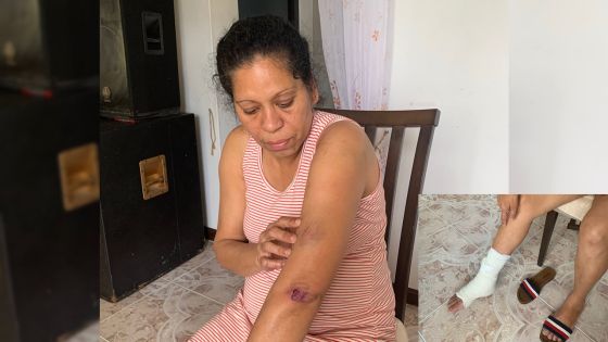 Trois femmes percutées sur un arrêt d’autobus - Elieta, rescapée : « Mo trouv sa loto-la vinn direk lor nou» - une des blessées amputée d’une jambe 