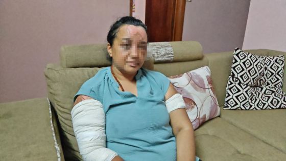 Victime de violence conjugale : Aarti, ébouillantée par son époux lors d’une dispute, veut tourner la page