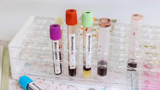 Variole du singe: 1 000 cas, l'OMS craint que le virus s'installe dans les pays non endémiques