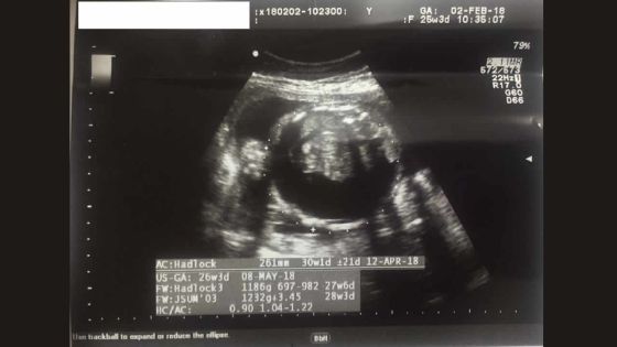 Allégation de négligence médicale : elle perd son bébé un jour après l’accouchement