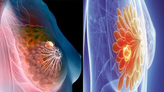 Comment surmonter un cancer du sein?